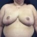 Breast Reduction 13 After Patient