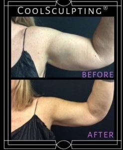 left-upper-arm-05.10.2018-4513765.left-upper-arm-10.09.2018-5653988-blog-ba-img