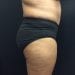 Tummy Tuck 27 After Patient