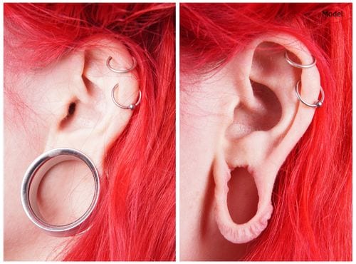 An image showing the effects a large ear gauge can have on earlobes, leaving gaping holes and stretched tissue.