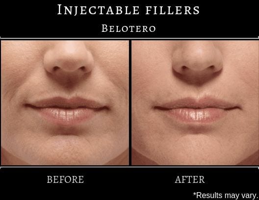 A woman before and after undergoing belotero treatment around her mouth and lips. Fine lines and wrinkles were reduced.
