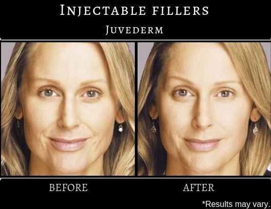 A woman before and after juvederm treatment who had improvement in facial volume, wrinkles, and fine lines throughout the face.