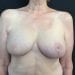 Breast Reduction 14 After Patient