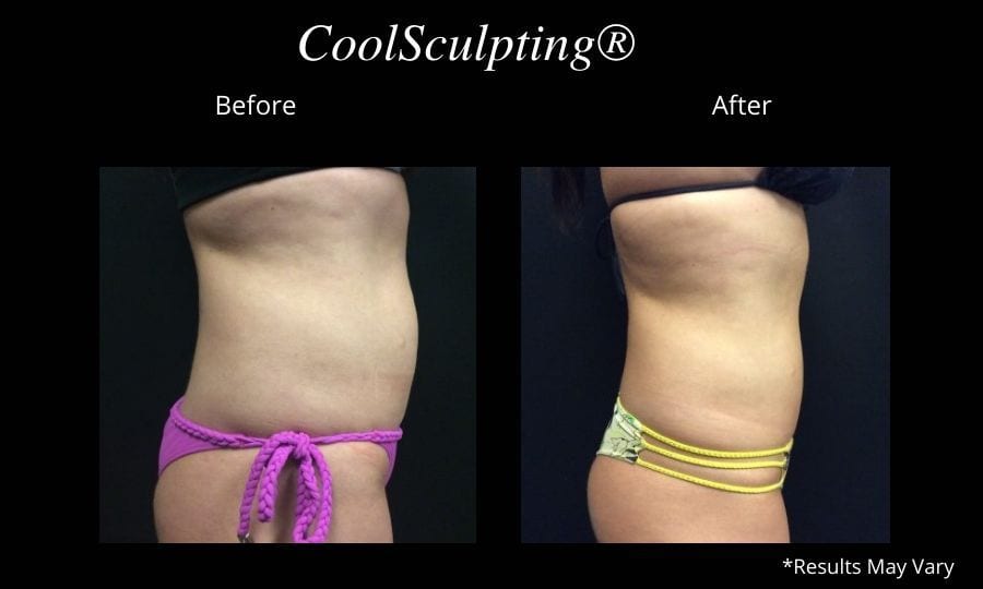 Before and after image showing the results of a CoolSculpting® procedure performed on the abdomen in San Diego, California.