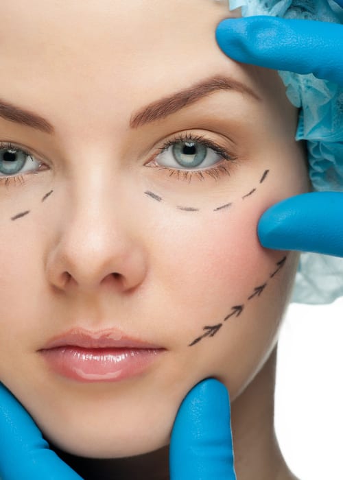 Woman with surgical lines drawn on face mimicking those of facelift surgery and eyelid surgery.