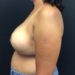 Breast Reduction 19 After - 2 Patient