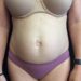 Tummy Tuck 30 Before Patient