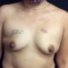 Breast Reconstruction 22 Before Patient