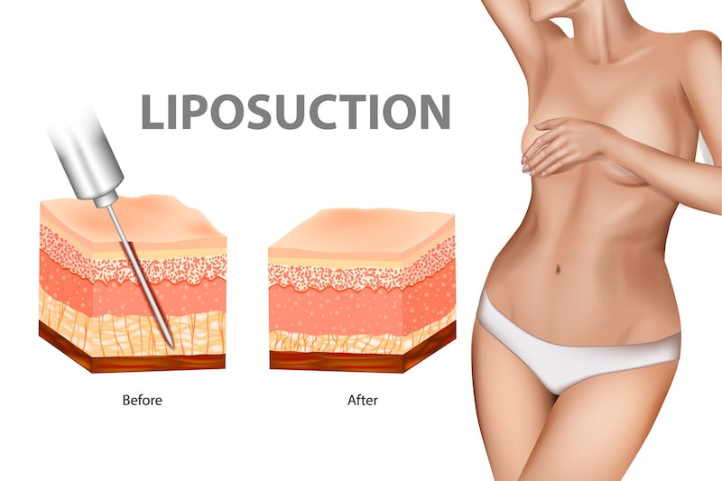 Vector illustration explaining how liposuction is performed.