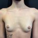 Breast Augmentation 27 Before Patient