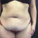 Tummy Tuck 35 Before Patient